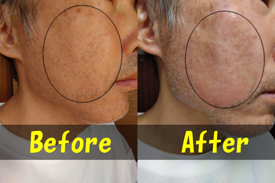 メンズTBCでヒゲ脱毛をする前の右頬の写真（左）と、メンズTBCでヒゲ脱毛をした後の右頬の写真（右）を、１枚に結合した画像。