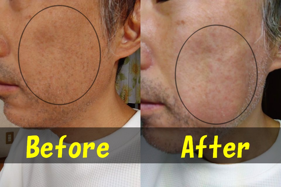 メンズTBCでヒゲ脱毛をする前の左頬の写真（左）と、メンズTBCでヒゲ脱毛をした後の左頬の写真（右）を、１枚に結合した画像。