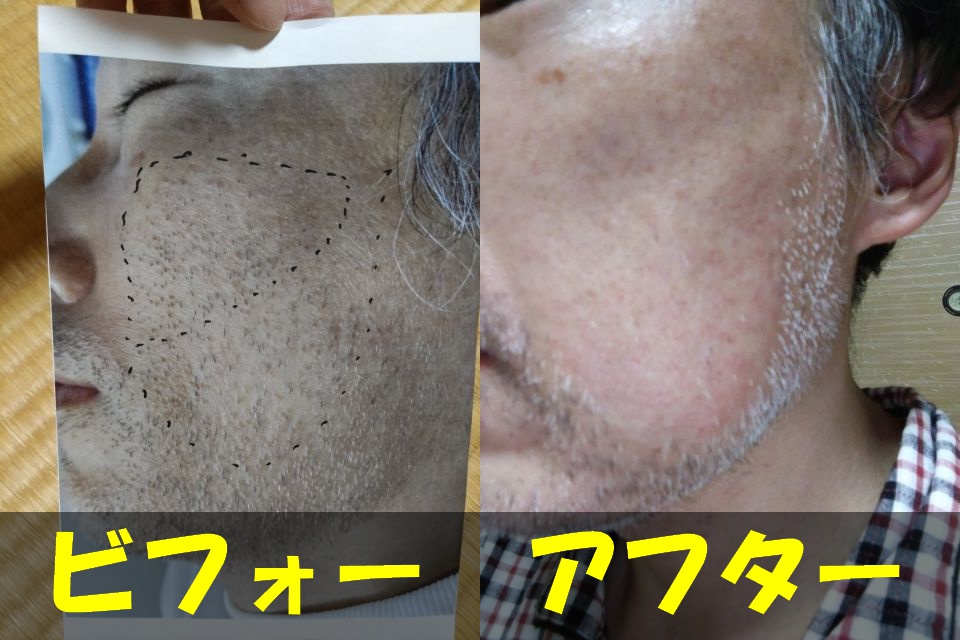 メンズTBCのヒゲ脱毛をする前の左頬の写真（左）と、メンズTBCヒゲ脱毛左右両頬８００本を抜き終わった左頬の写真（右）を結合した画像