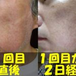メンズTBCヒゲ脱毛１回目直後の左頬の写真（左）と、メンズTBCヒゲ脱毛１回目から２日経過した左頬の写真（右）を結合した画像