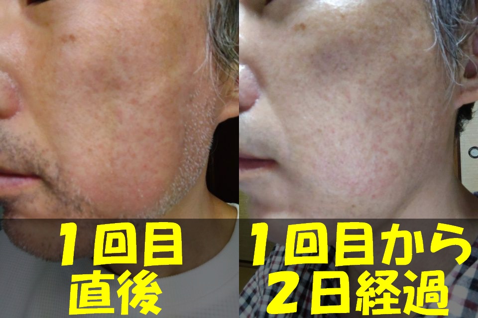 メンズTBCヒゲ脱毛１回目直後の左頬の写真（左）と、メンズTBCヒゲ脱毛１回目から２日経過した左頬の写真（右）を結合した画像