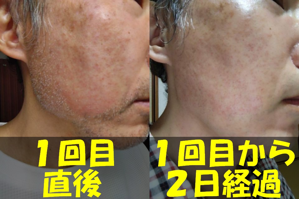 メンズTBCヒゲ脱毛１回目直後の右頬の写真（左）と、メンズTBCヒゲ脱毛１回目から２日経過した右頬の写真（右）を結合した画像