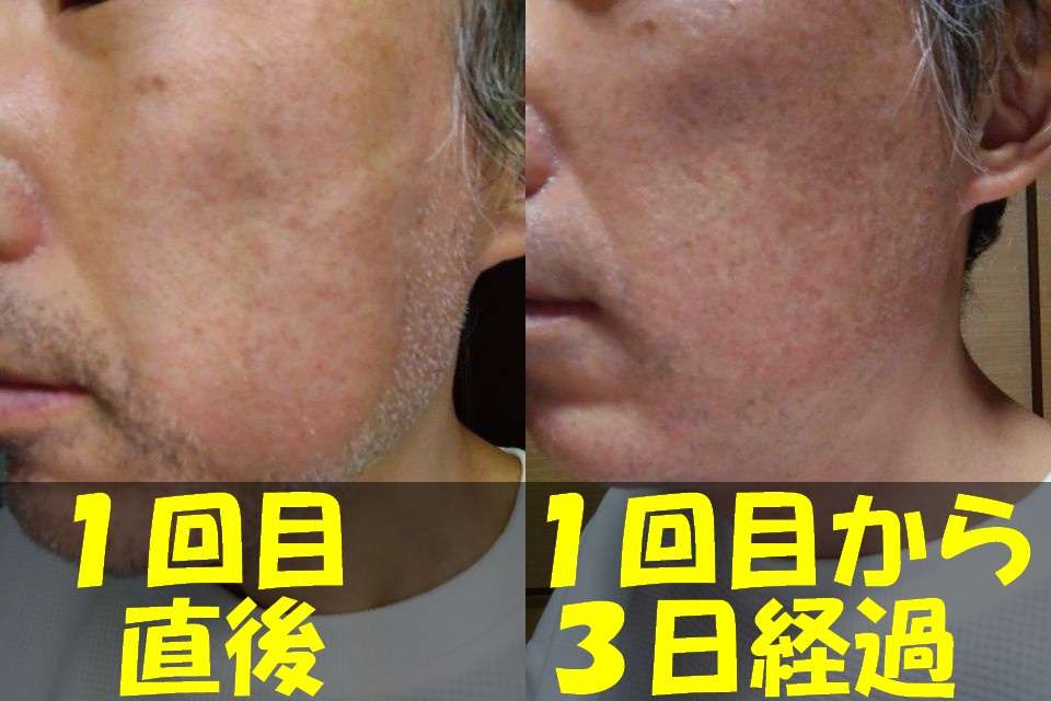 メンズTBCでヒゲ脱毛１回目直後の左頬写真（左）と、メンズTBCでヒゲ脱毛してから３日経過した左頬写真（右）を結合した画像