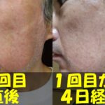 メンズTBCヒゲ脱毛１回目直後の左頬の写真（左）と、メンズTBCヒゲ脱毛１回目から４日経過した左頬の写真（右）を結合した画像