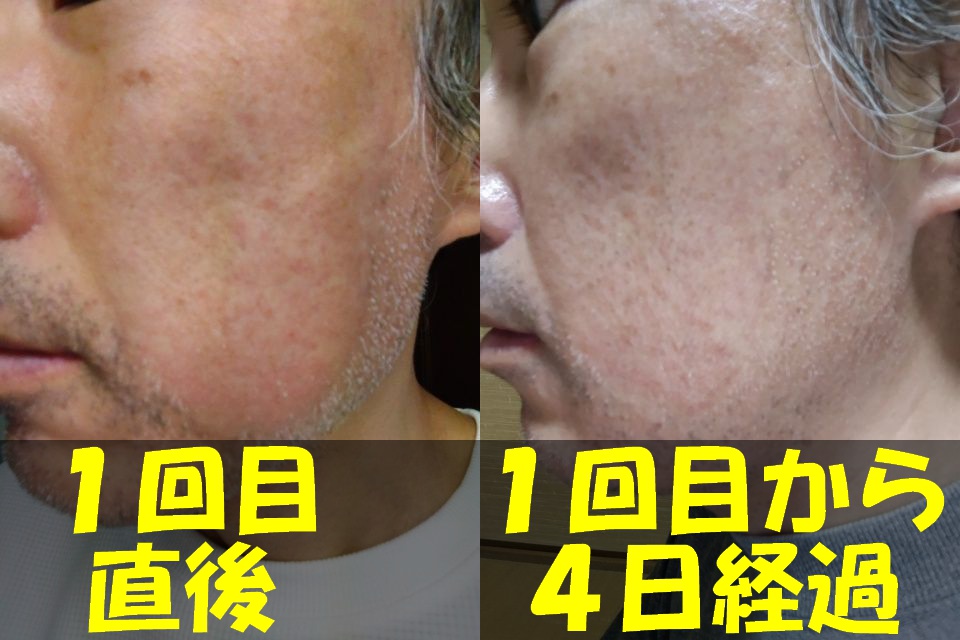メンズTBCヒゲ脱毛１回目直後の左頬の写真（左）と、メンズTBCヒゲ脱毛１回目から４日経過した左頬の写真（右）を結合した画像