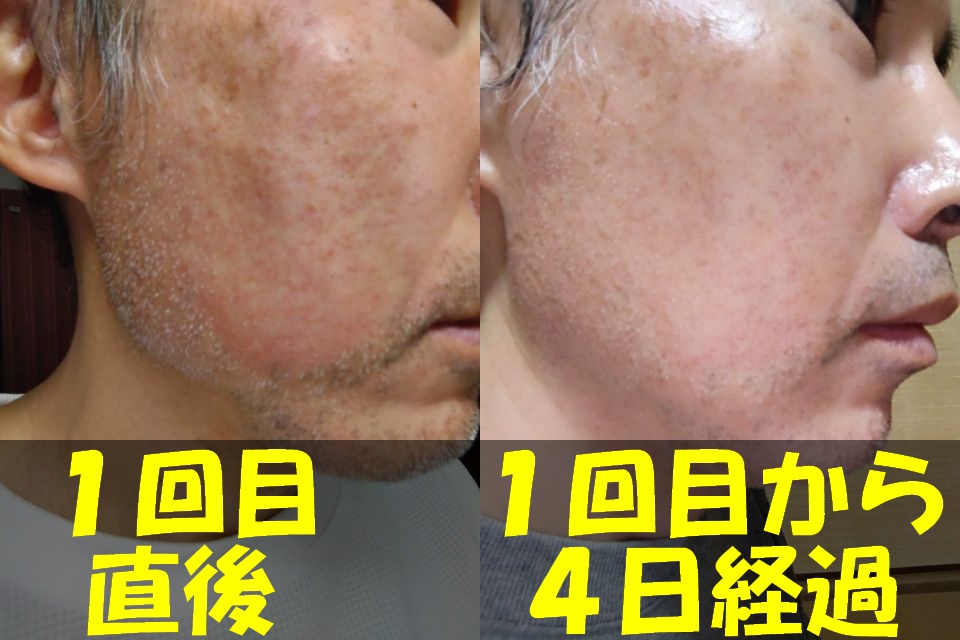 メンズTBCヒゲ脱毛１回目直後の右頬の写真（左）と、メンズTBCヒゲ脱毛１回目から４日経過した右頬の写真（右）を結合した画像