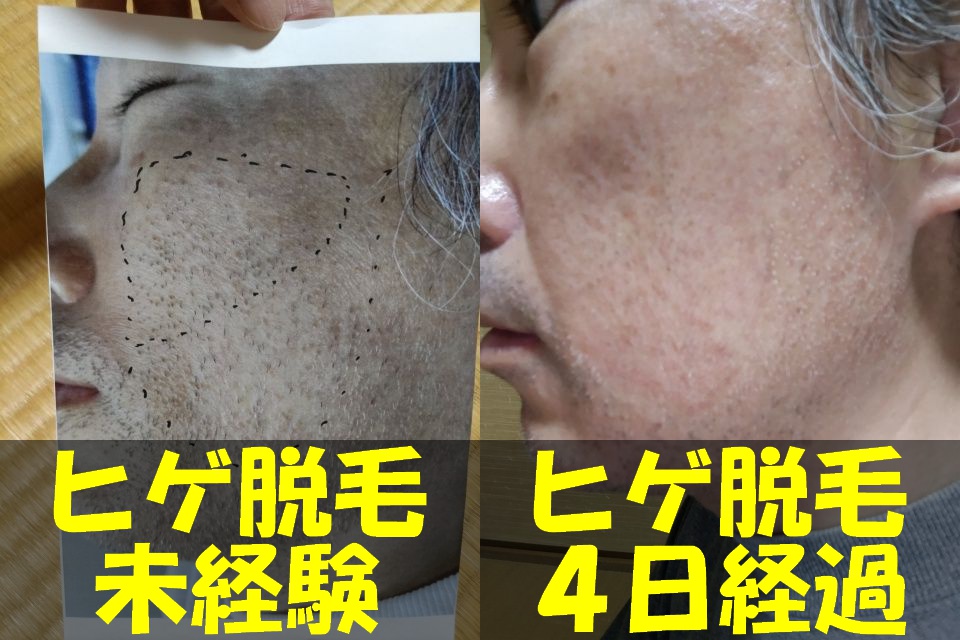 メンズTBCヒゲ脱毛体験コースを受ける直前の左頬の写真（左）と、メンズTBCヒゲ脱毛１回目から４日経過した左頬の写真（右）を結合した画像
