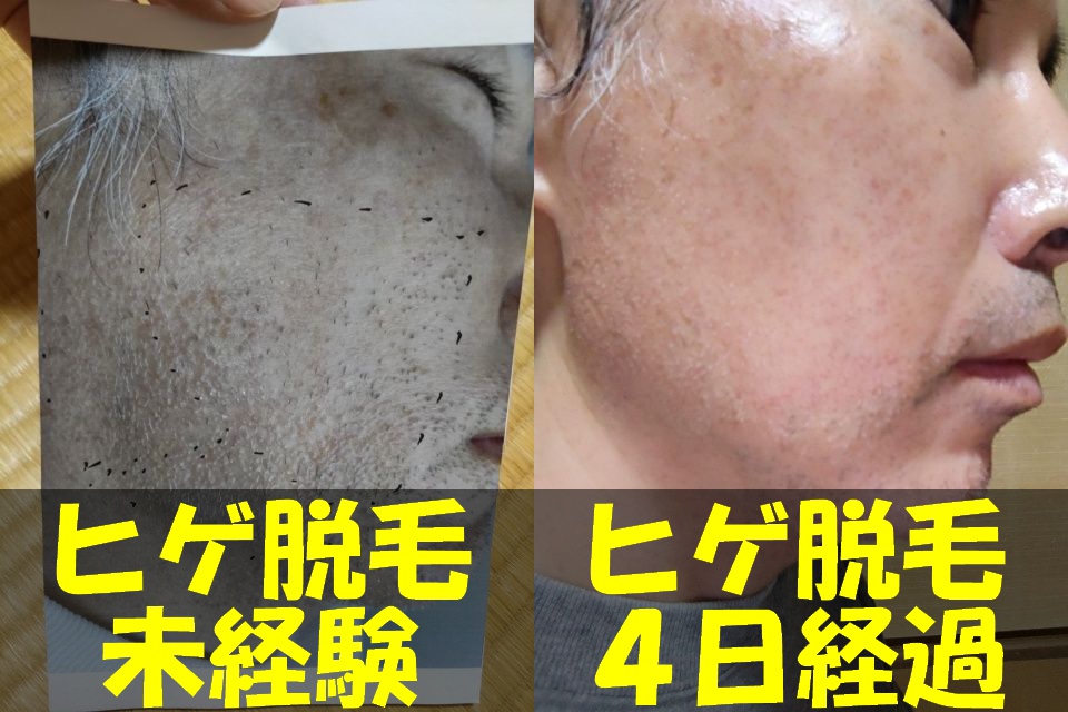 メンズTBCヒゲ脱毛体験コースを受ける直前の右頬の写真（左）と、メンズTBCヒゲ脱毛１回目から４日経過した右頬の写真（右）を結合した画像