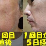 メンズTBCヒゲ脱毛１回目直後の左頬の写真（左）と、メンズTBCヒゲ脱毛１回目から５日経過した左頬の写真（右）を結合した画像