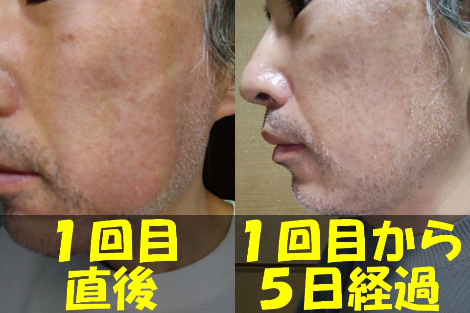 メンズTBCヒゲ脱毛１回目直後の左頬の写真（左）と、メンズTBCヒゲ脱毛１回目から５日経過した左頬の写真（右）を結合した画像