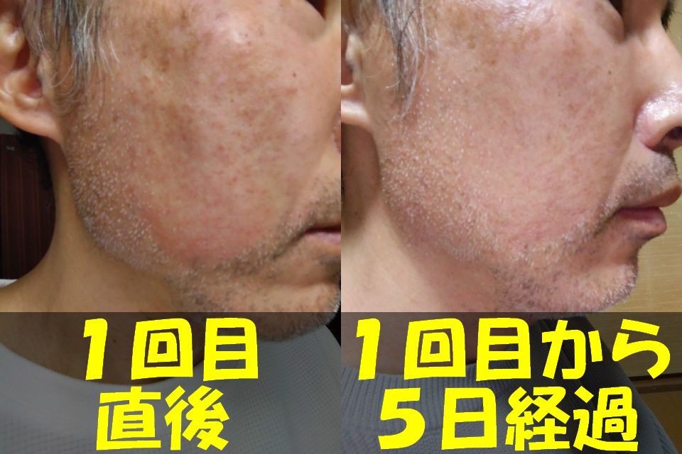 メンズTBCヒゲ脱毛１回目直後の右頬の写真（左）と、メンズTBCヒゲ脱毛１回目から５日経過した右頬の写真（右）を結合した画像