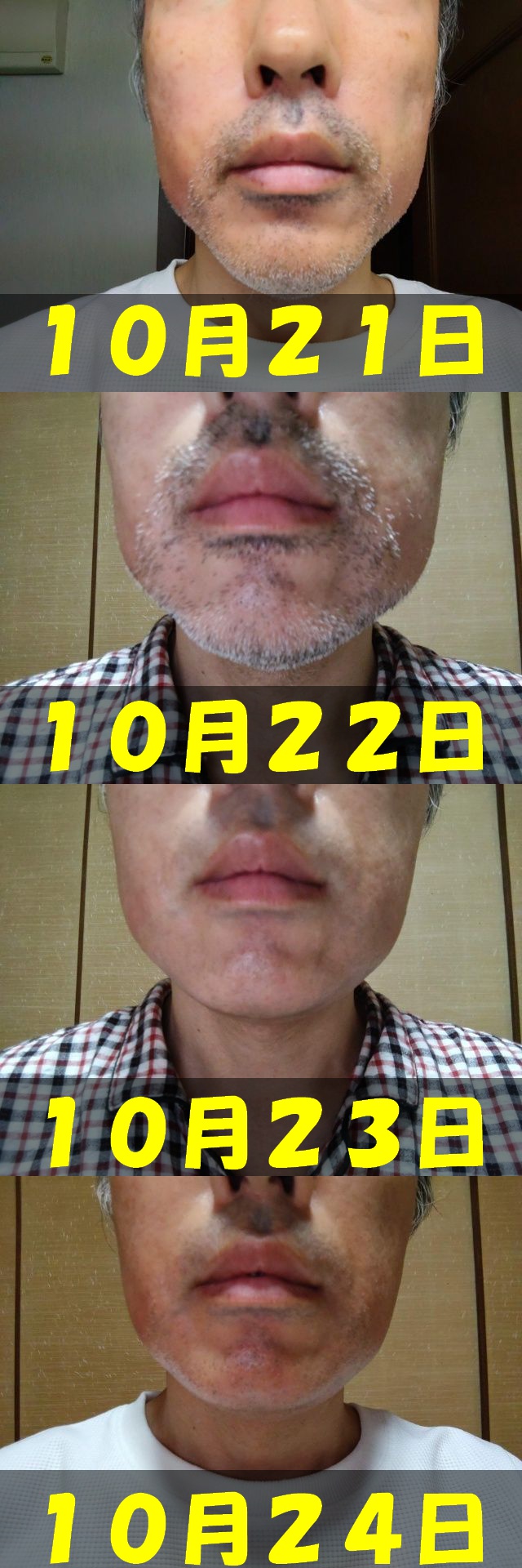 腫れの比較画像。１０月２１日から１０月２４日までの顔正面画面を１枚に結合した画像。