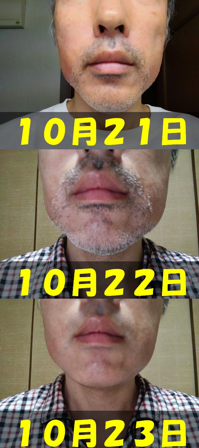腫れの比較画像。１０月２１日から１０月２３日まで毎日正面顔写真を撮影し、その写真を１枚に結合した画像。