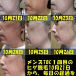 メンズTBC１回目のヒゲ脱毛１０月２１日から１０月２７日まで毎日左頬の写真撮影を行い、経過を比較できるように、毎日撮影した写真を１枚に結合した画像。