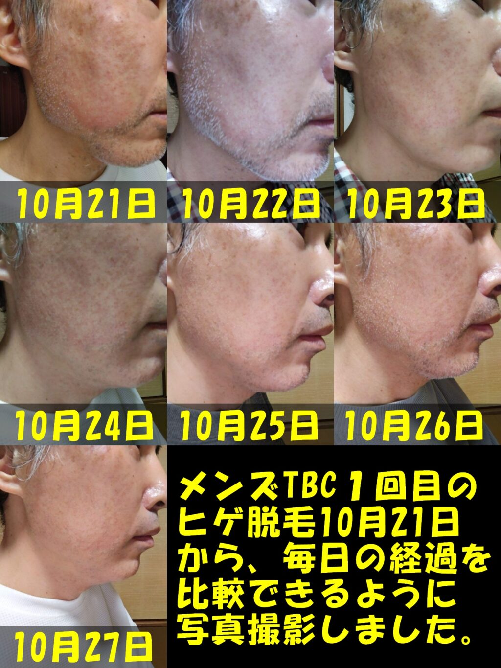 メンズTBC１回目のヒゲ脱毛１０月２１日から１０月２７日まで毎日右頬の写真撮影を行い、経過を比較できるように、毎日撮影した写真を１枚に結合した画像。